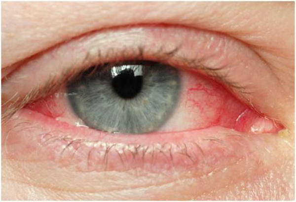 Đau Mắt Đỏ Lây Qua Đường Nào? Nhìn mắt người bệnh có bị lây không? cách phòng tránh